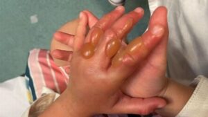 School’s warning after child, 4, suffers second-degree burns from ‘Britain’s most dangerous plant’