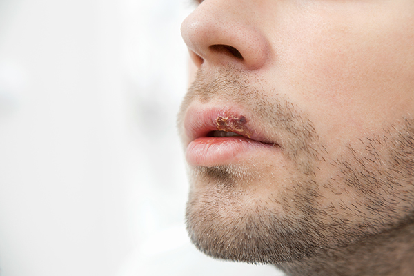 Herpes Zoster (Shingles)