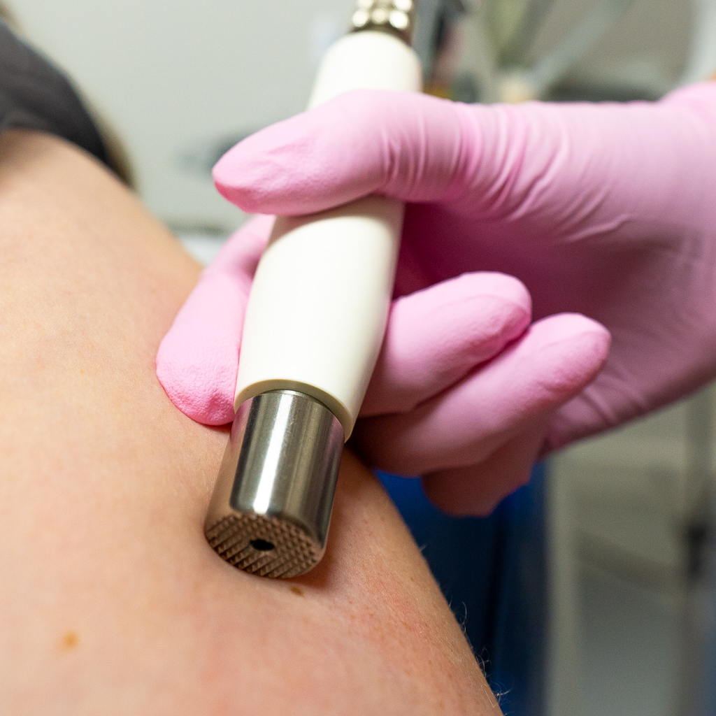 What To Look For With Stretch Mark Treatments