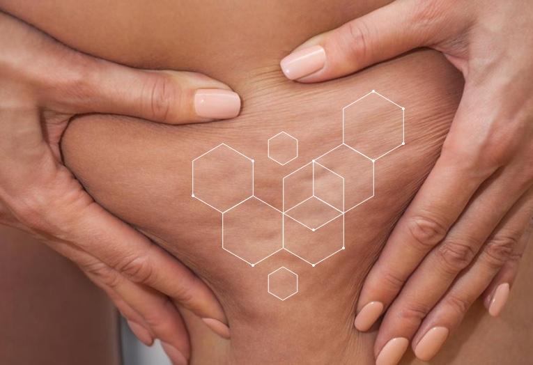 How Bad Is My Cellulite? Advice on Cellulite Build-Up & How To Treat It