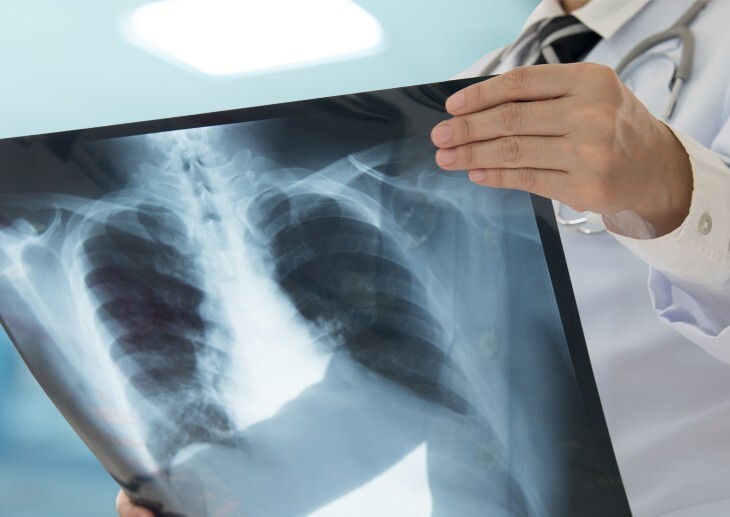 A doctor holding a lung x-ray.