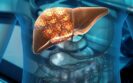 A digital 3D illustration of a human body with the liver highlighted in brown and showing liver cancer cell growth to illustrate uveal melanoma liver metastases and what oncologists need to know about the latest treatments