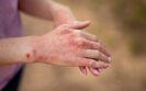 A close up of the hands of a woman in a purple tshirt with one hand on top of the other with moderate-to-severe atopic dermatitis to illustrate the impact of discontinuing dupilumab therapy