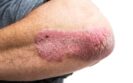 A close up image of a bent elbow affected by psoriasis to illustrate that early response to biologics such as risankizumab and guselkumab has been found to predict long-term treatment success in psoriasis