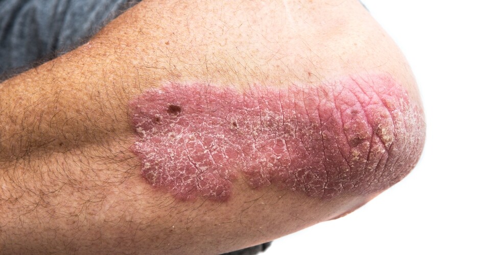 A close up image of a bent elbow affected by psoriasis to illustrate that early response to biologics such as risankizumab and guselkumab has been found to predict long-term treatment success in psoriasis