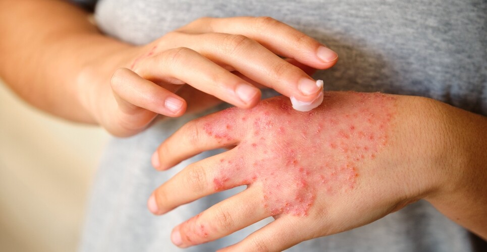 Delgocitinib recommended by NICE for chronic hand eczema