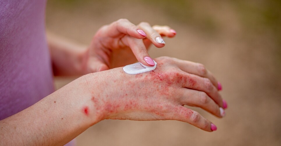 A close up of a woman applying topic treatment to chronic hand eczema to illustrate the results of a new real-world review