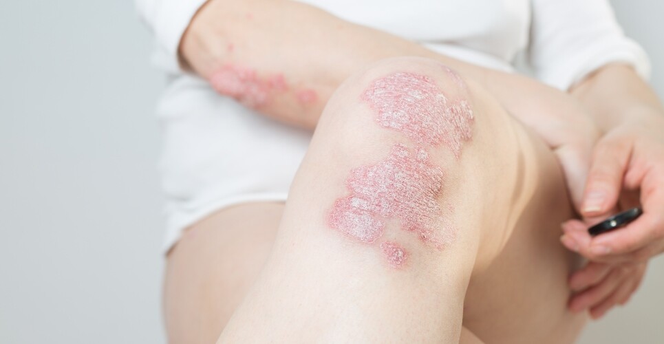 A woman wearing a white top and shorts sitting on a chair with her legs crossed and psoriasis visible on her legs and arms to illustrate the finding that tildrakizumab has positive impact on psychological wellbeing in psoriasis