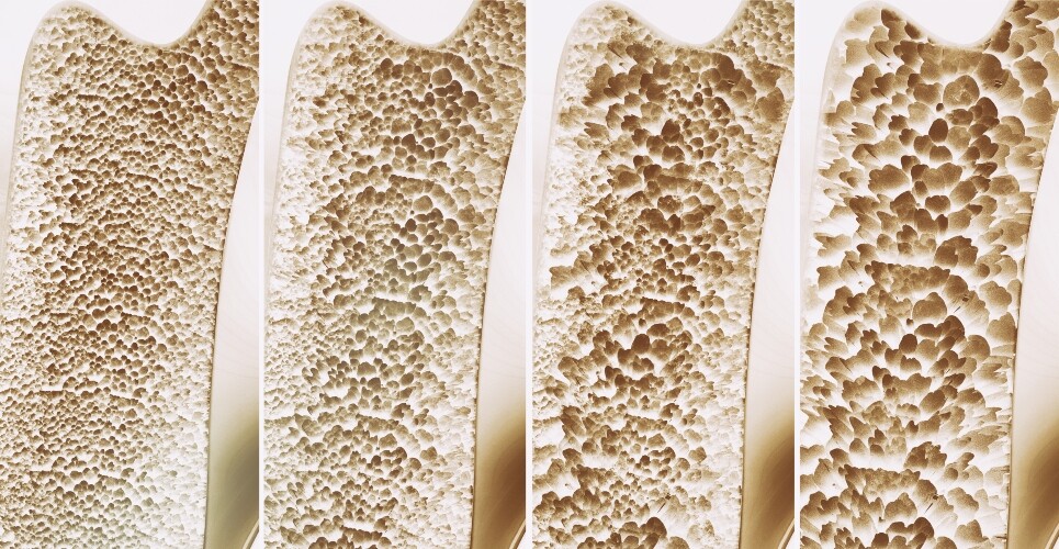 A 3D rendering of four stages of osteoporosis to illustrate a landmark decision resulting from the SABRE project on recognising changes in total hip BMD as a new surrogate endpoint for fracture risk reduction in postmenopausal osteoporosis trials