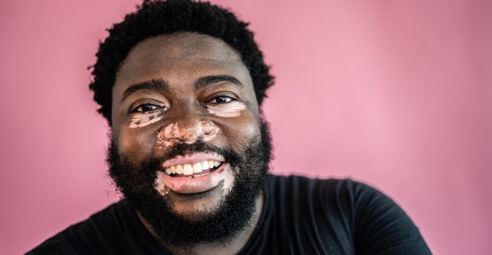 A close-up of a man with vitiligo to illustrate the NICE approval of ruxolitinib for non-segmental vitiligo