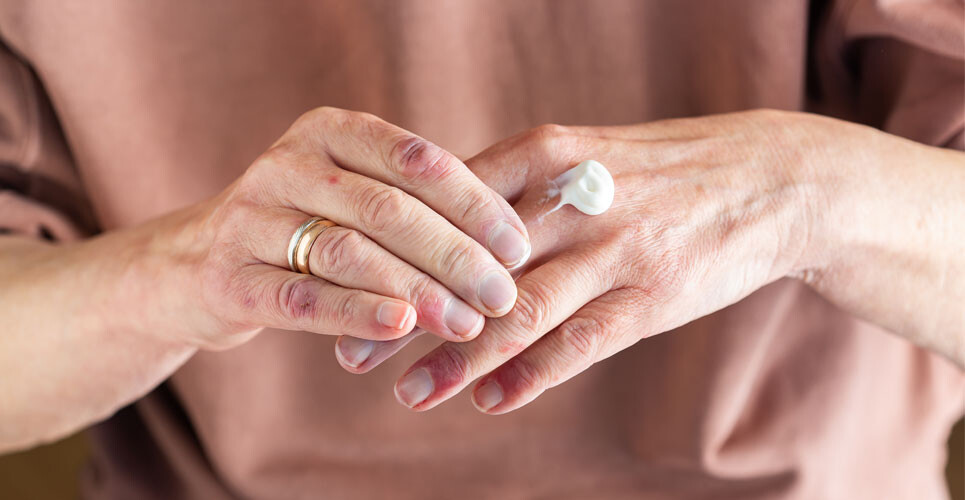 A close up of a woman applying cream to her hands to illustrate the fact that delgocitinib cream has been found to boost quality of life in chronic hand eczema