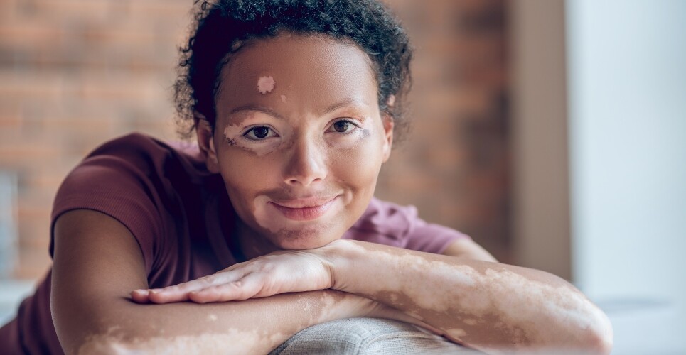 A young woman with vitiligo on her face and arms leaning on her hands and smiling at the camera to illustrate an interview with Associate Professor Viktoria Eleftheriadou