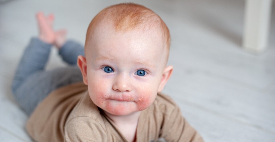 Dupilumab shows sustained benefits for paediatric severe AD in first long-term analysis
