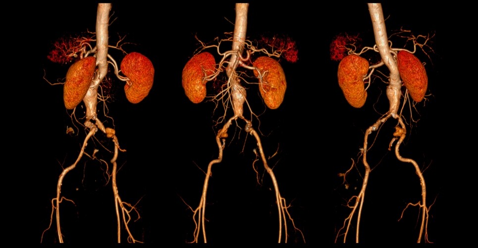 Horizon scanning: metformin for abdominal aortic aneurysm