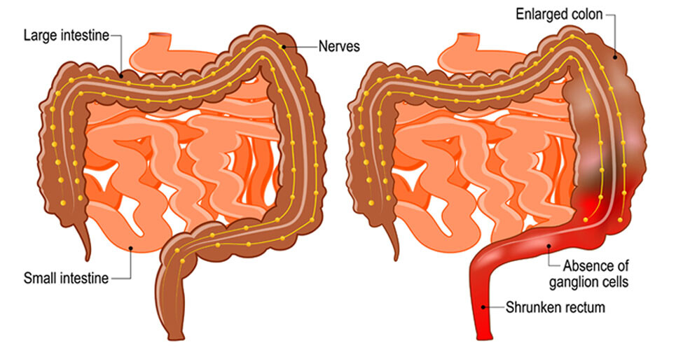 Horizon scanning: stem cell therapy for Hirschsprung disease