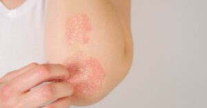 Psorasis on the elbow