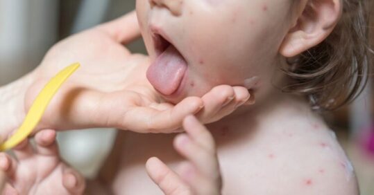 Mythbuster: ‘Chickenpox is only a mild childhood illness, there’s no need to vaccinate children against it’