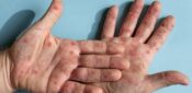 CPD: Recognising and managing rashes in sexually transmitted infections