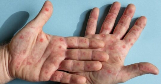 CPD: Recognising and managing rashes in sexually transmitted infections