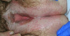 Medical image showing classic pattern of lesions in vulval lichen sclerosis