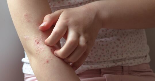 Bathing frequency has no effect on eczema symptoms, finds study