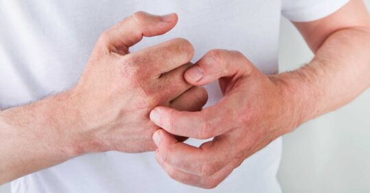 NICE recommends new treatment option for chronic hand eczema