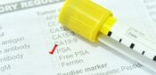 National committee to advise against routine NHS prostate cancer screening