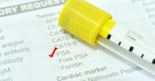 National committee to advise against routine NHS prostate cancer screening
