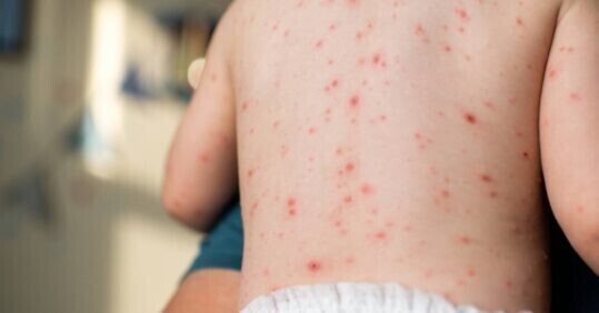 GP practices to begin offering chickenpox vaccination