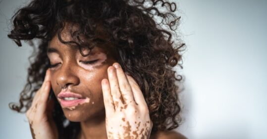 NHS to offer first licensed vitiligo treatment