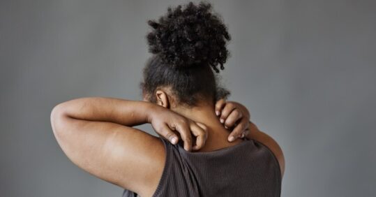 How to recognise and treat eczema in skin of colour