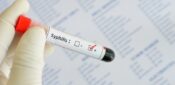 Syphilis cases rising worldwide: what nurses need to know
