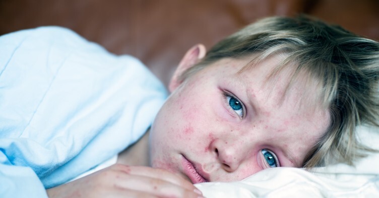 Two children have died from measles in England this year, new UKHSA data shows