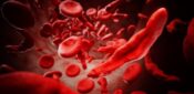 Sickle cell disorder: what primary care nurses need to know