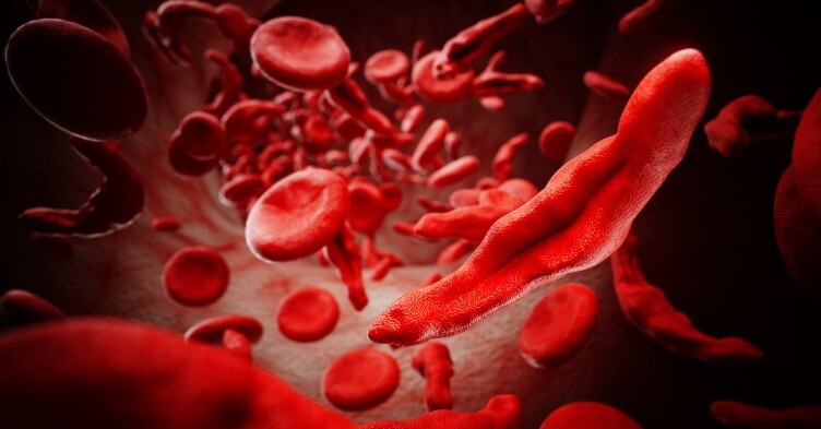 Sickle cell disorder: what primary care nurses need to know