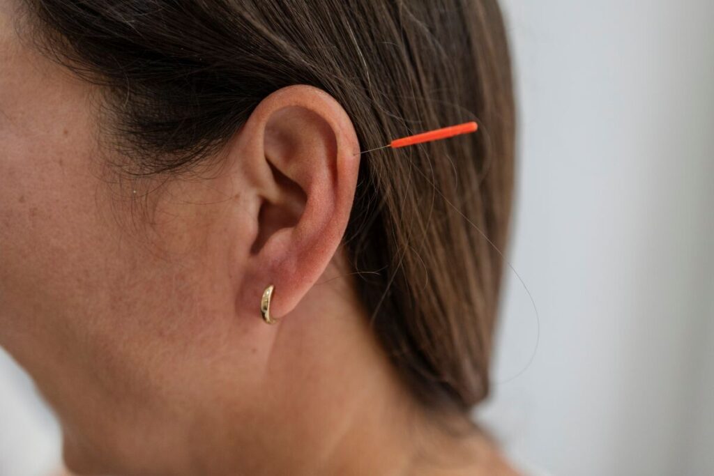 acupuncture needle in woman's ear
