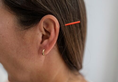 acupuncture needle in woman's ear