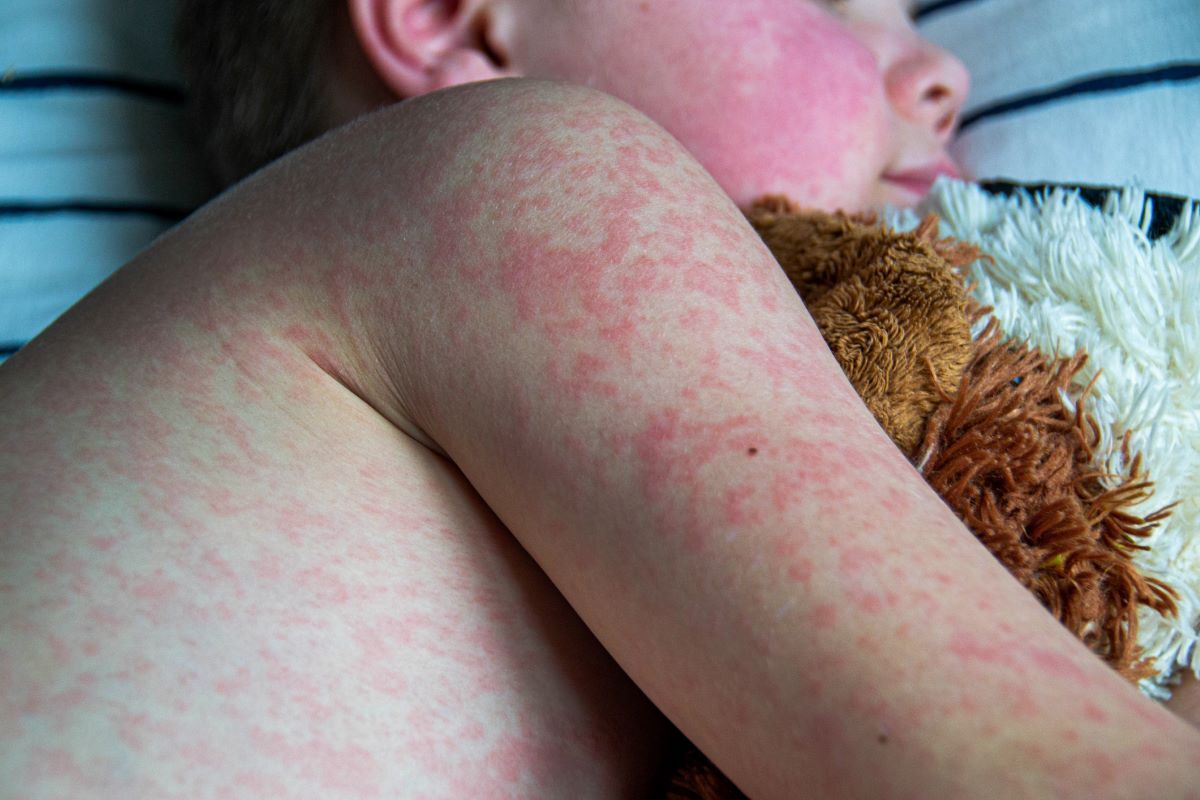 Two children have died from measles this year as cases reported across England
