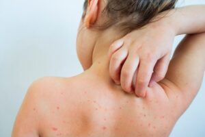GP practices to offer chickenpox vaccine from January next year