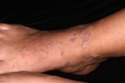 What’s causing this woman’s chronic rash on her ankles, feet and wrists?