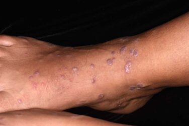 What’s causing this woman’s chronic rash on her ankles, feet and wrists?