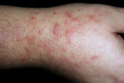 What is the cause of this extremely itchy bilateral wrist rash?