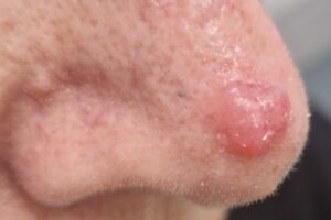 How to recognise amelanotic melanoma