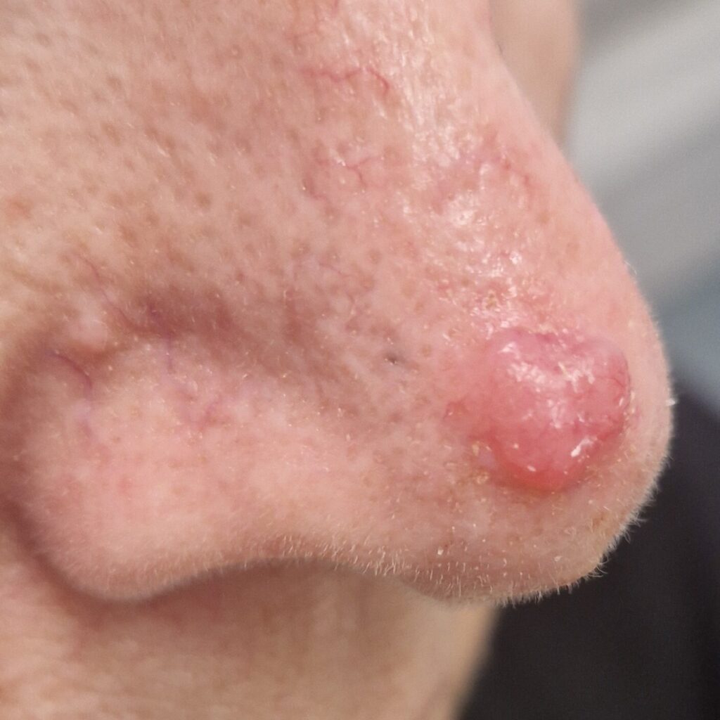 what does melanotic mean This lovely patient was thrilled with her beautiful result after laser  treatment of oral melanotic macules. I share this case to educate: laser  treatment requires accurate diagnosis, an understanding