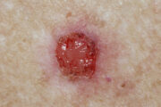 CPD: Casebook – skin cancer and pre‑cancer