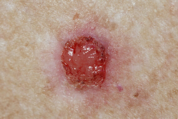 CPD: Casebook – skin cancer and pre‑cancer