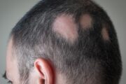 What’s the diagnosis in this case of patchy hair loss?