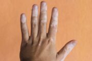 What’s causing these pale patches of skin?