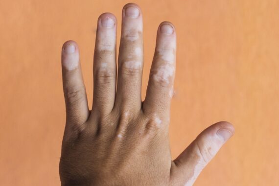 What’s causing these pale patches of skin?