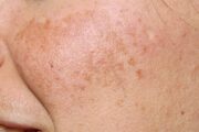 What’s causing this facial rash involving darker patches of skin?